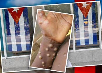 Cuba registra su tercer caso de viruela del mono