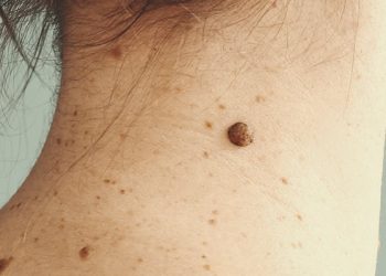 Este compuesto ayudaría a combatir el melanoma
