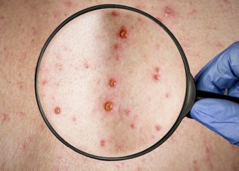 Alertan científicos sobre mutación del virus de la Viruela del Mono