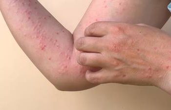 ¿Cuántos casos hay en México de viruela del mono?