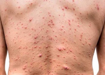 Estos son los casos de viruela del mono confirmados en la CDMX