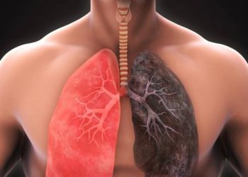 El EPOC no siempre se logra diagnosticar a tiempo