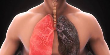 El EPOC no siempre se logra diagnosticar a tiempo