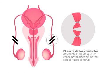 IMSS lleva a cabo jornada intensiva de vasectomía