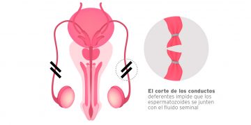 IMSS lleva a cabo jornada intensiva de vasectomía