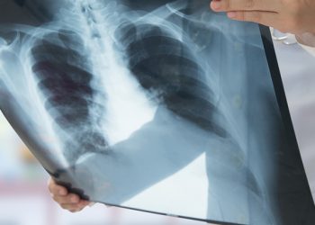 Alertan especialistas por diagnósticos tardíos de cáncer de pulmón