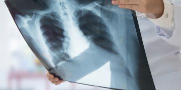 Alertan especialistas por diagnósticos tardíos de cáncer de pulmón
