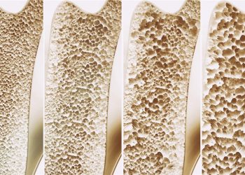 Prevé la Osteoporosis