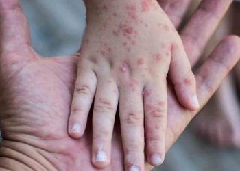 Reducción de medidas para el control sarampión pone en riesgo a 40 millones de niños, advierte la OMS