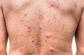 OMS mantiene nivel de alerta máxima para viruela del mono