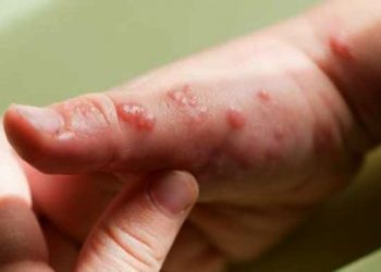 Niños menores de 8 años deberían ser vacunados contra la viruela del mono
