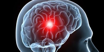 ¿Qué relación tiene la hipertensión y la demencia? Esto dice estudio