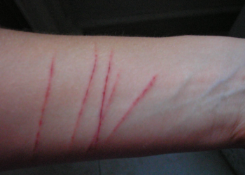 Autolesiones de adolescentes crecen tras la pandemia, según experta