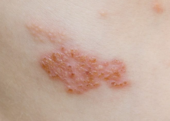 Vacuna contra el Herpes Zóster protege y previene en más del 90% ¿Cuánto cuesta y dónde se consigue?