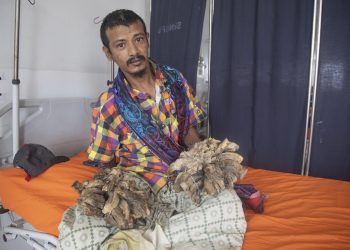 El “hombre árbol” reingresa a hospital, te contamos