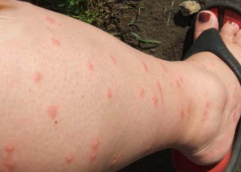 Científicos alertan sobre una nueva epidemia en América