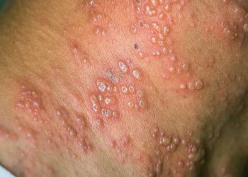 La OMS levanta emergencia internacional por la viruela símica tras 10 meses de alerta