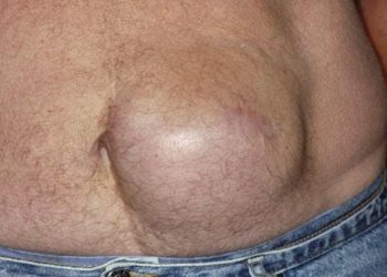 Qué es una hernia incisional y por qué se debe operar el Papa Francisco