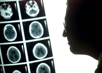 Nuevo estudio abre camino a la detección precoz de la metástasis cerebral