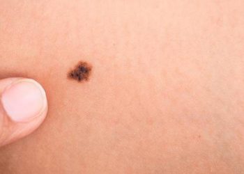 Combinar dos fármacos ayuda a prolongar la vida de los pacientes con melanoma metastásico