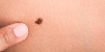 Combinar dos fármacos ayuda a prolongar la vida de los pacientes con melanoma metastásico