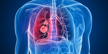 México registra más de 7 mil nuevos casos de cáncer de pulmón cada año