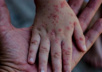 OMS alerta del aumento alarmante de casos de sarampión en Europa