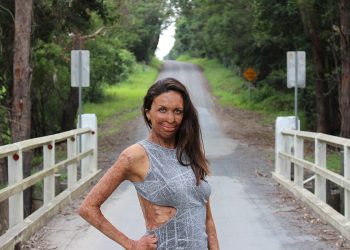 Turia Pitt y su amor para curar 65% de piel quemada