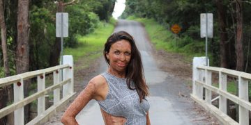 Turia Pitt y su amor para curar 65% de piel quemada