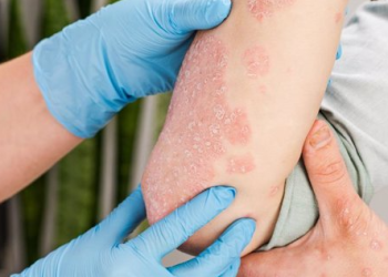 Expertos presentan una terapia para enfermedad rara