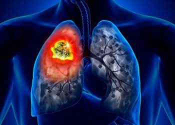 El cáncer de pulmón se mantiene como el más mortal: OMS