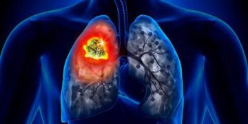 El cáncer de pulmón se mantiene como el más mortal: OMS