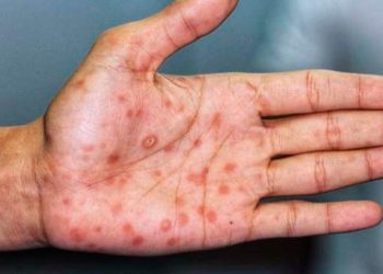 Más de la mitad de los países sufrirán alto riesgo de brotes de sarampión este año, alerta la OMS