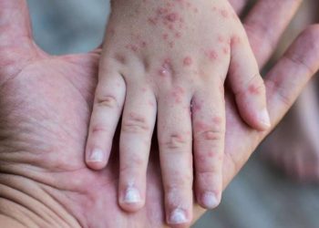 ¿Hay un brote de casos de sarampión en el país? Un especialista nos aclara