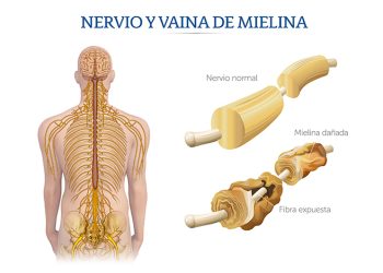 ¿Qué es el Síndrome de Guillain-Barré y por qué emitieron alerta en Tlaxcala? Te contamos