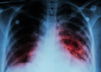 OMS pide inversión para frenar la tuberculosis, que cada año mata 1,3 millones de personas