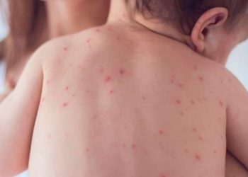 ¿Sabías que el sarampión es una enfermedad altamente contagiosa? Un especialista nos cuenta