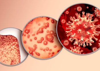 ¿Cuántos casos de mpox hay en México?
