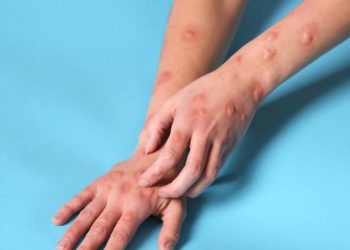 OMS recomienda el uso de mascarillas solo en personal sanitario y cuidadores de enfermos de mpox