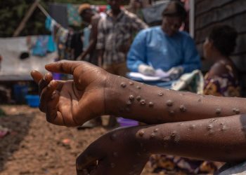 mpox