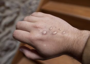 Brote de mpox en África incluye diferentes variantes y modos de transmisión