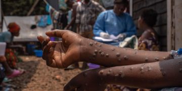 mpox