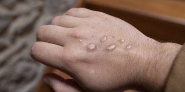 Brote de mpox en África incluye diferentes variantes y modos de transmisión