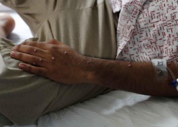 África alcanza los 622 muertos por la mpox