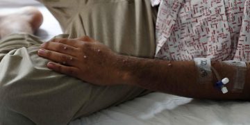 África alcanza los 622 muertos por la mpox