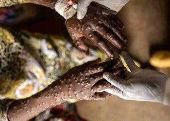 África acumula más de 29,000 casos y 738 muertes por mpox