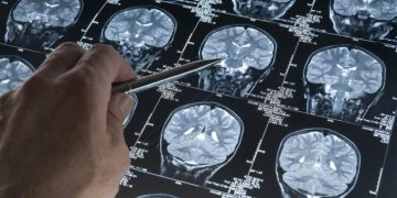 alzheimer