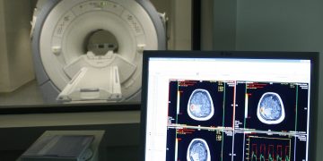 Día mundial del Alzheimer: estos factores lo detonan