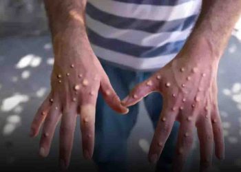África registra cerca de 26,550 casos y 724 muertes por mpox