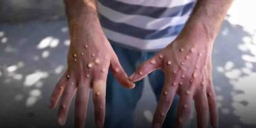 África registra cerca de 26,550 casos y 724 muertes por mpox